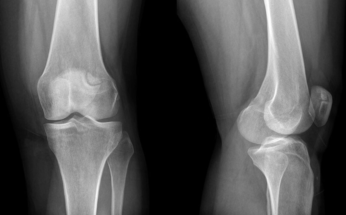 Arthroza kolena na x -ray pred uporabo hondroina
