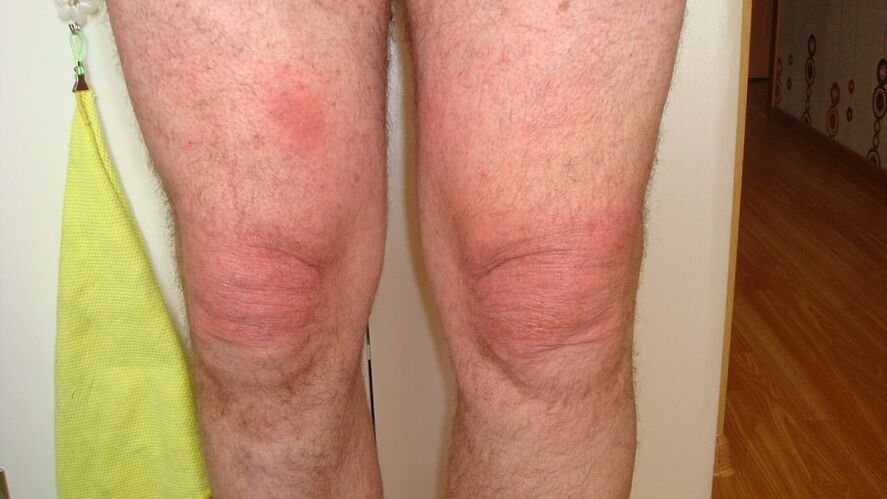 Arthroza kolenskih sklepov